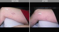 Chicago Spider Vein Removal 